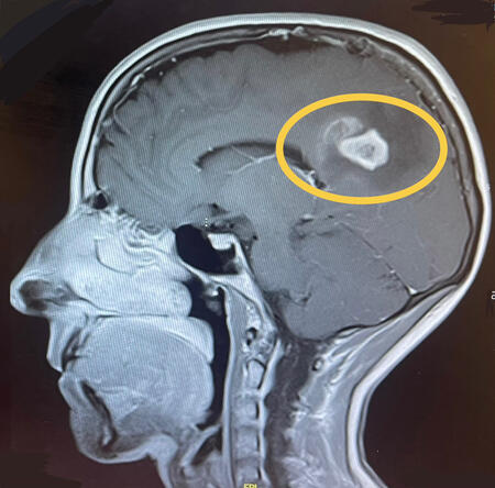 Undergoing radiotherapy