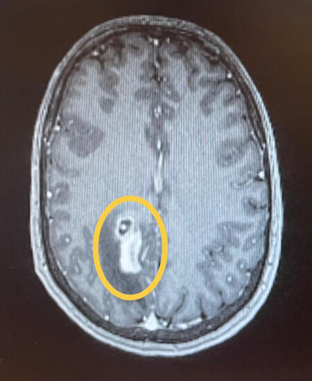 Undergoing radiotherapy